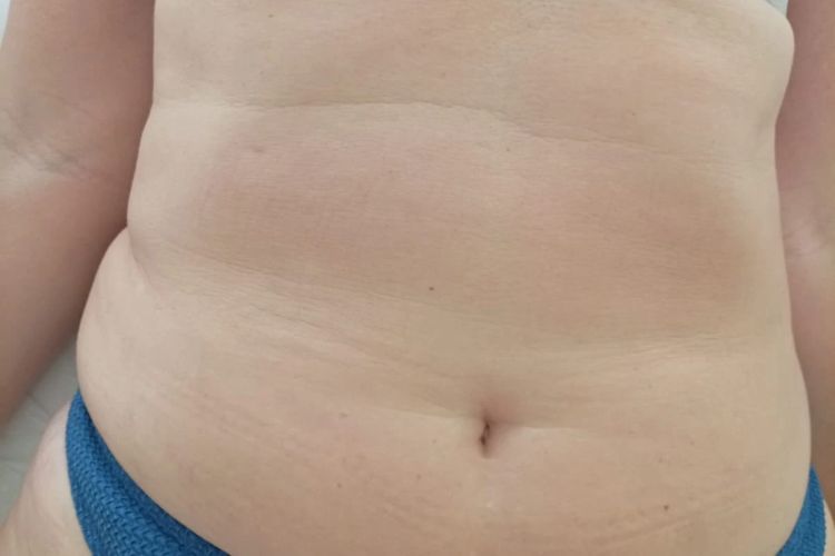 Abdômen antes da massagem modeladora