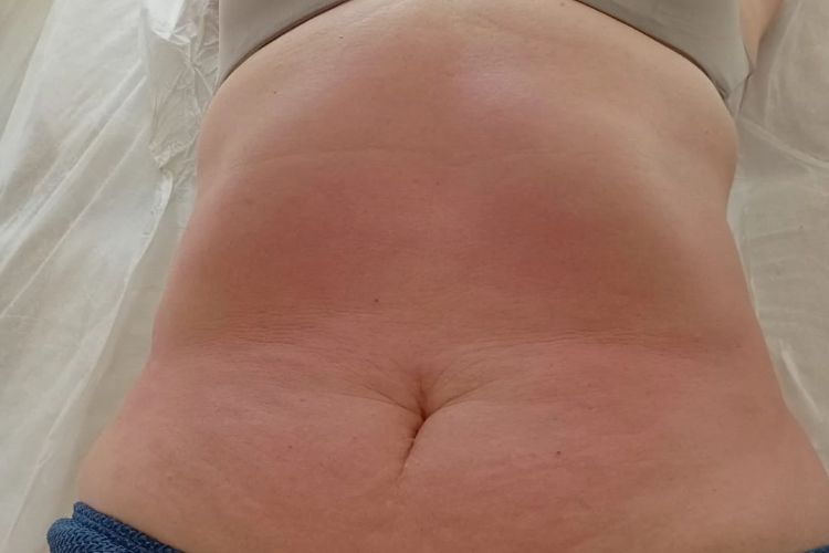 Abdômen depois da massagem modeladora